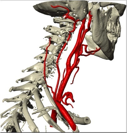 intra arterial