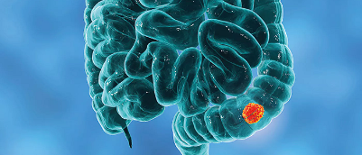 Graphic of cancer screening of human intestines with orange circle