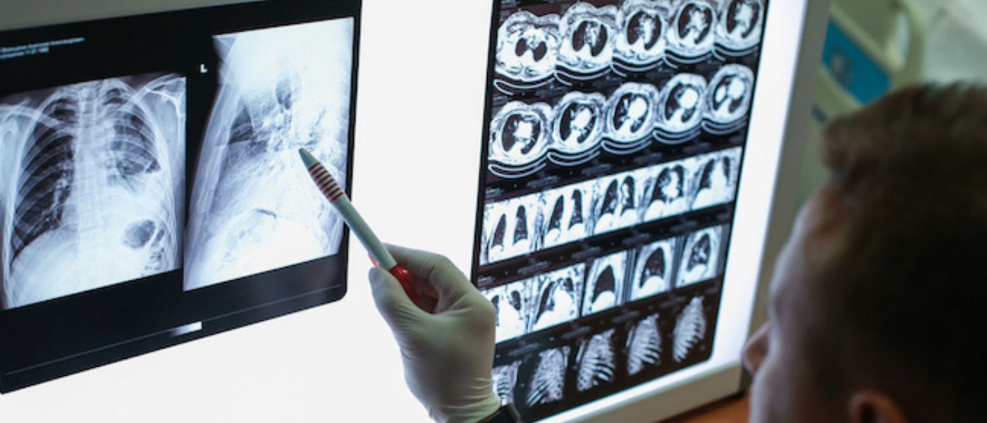 A doctor reviewing a lung scan
