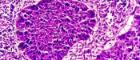 Mouth cancer cells